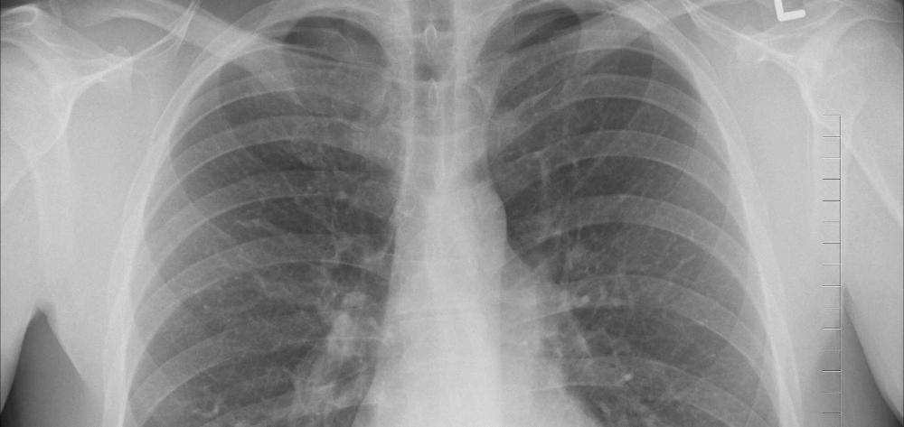 Radiografía pulmones