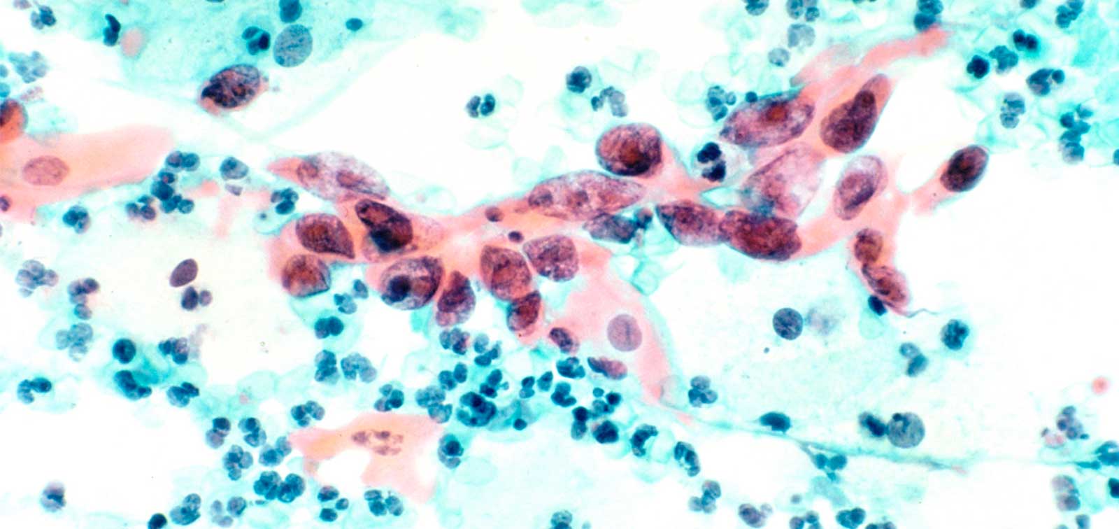 virus papiloma es cancer