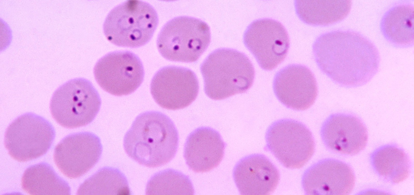 Microscopy image of erithrocytes infected with malaria parasite