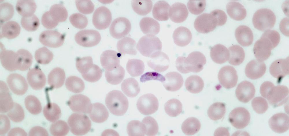 Gametocit de 'Plasmodium falciparum'