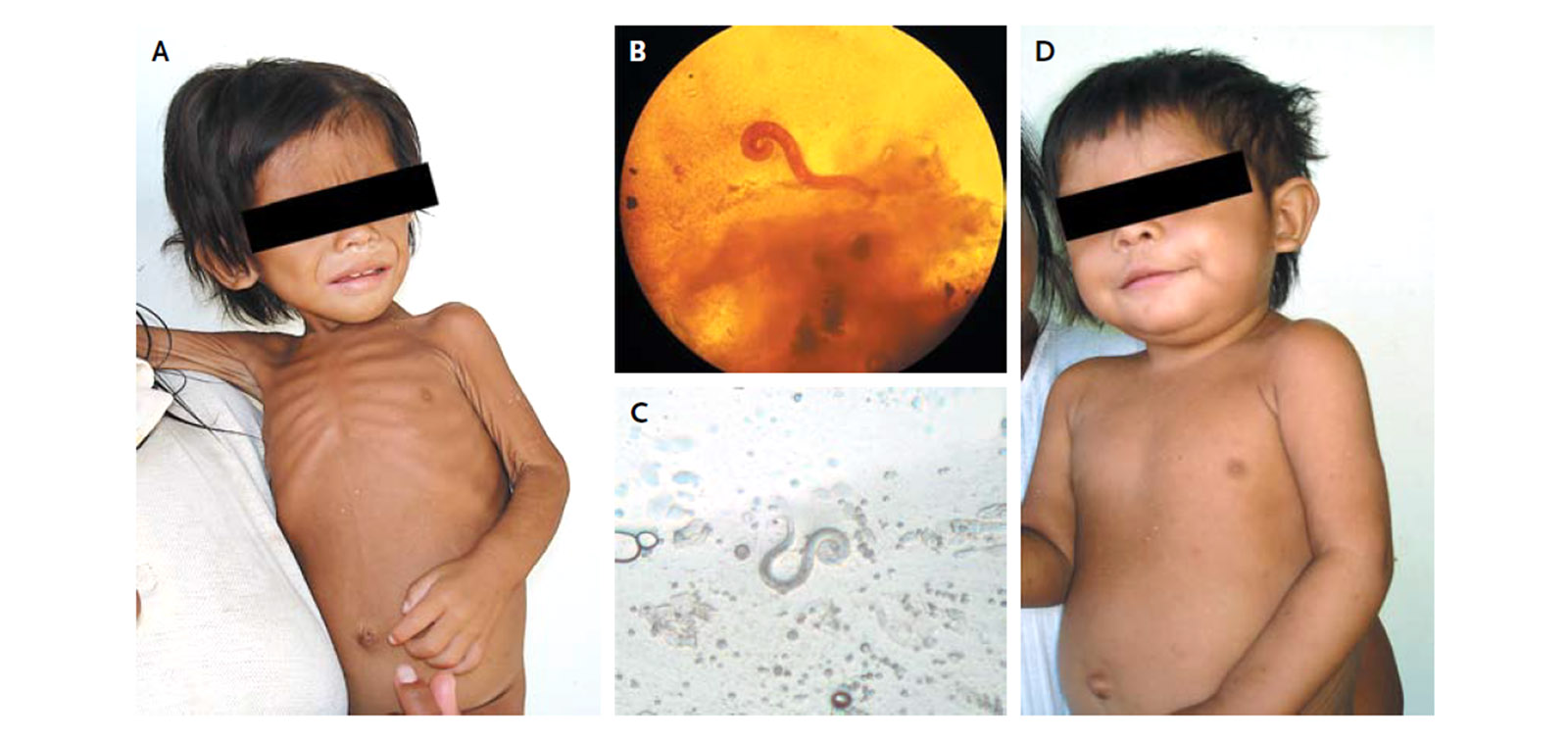 Una niña de dos años con estrongiloidiasis diseminada curada con ivermectina (A) antes, (B) muestra fecal, (C) muestra de esputo y (D) seis semanas después del tratamiento.